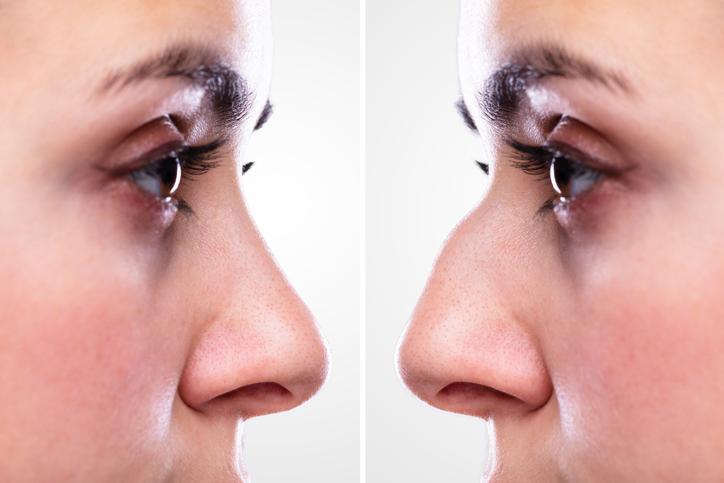导航鼻整形术:手术前，手术中和手术后的期望